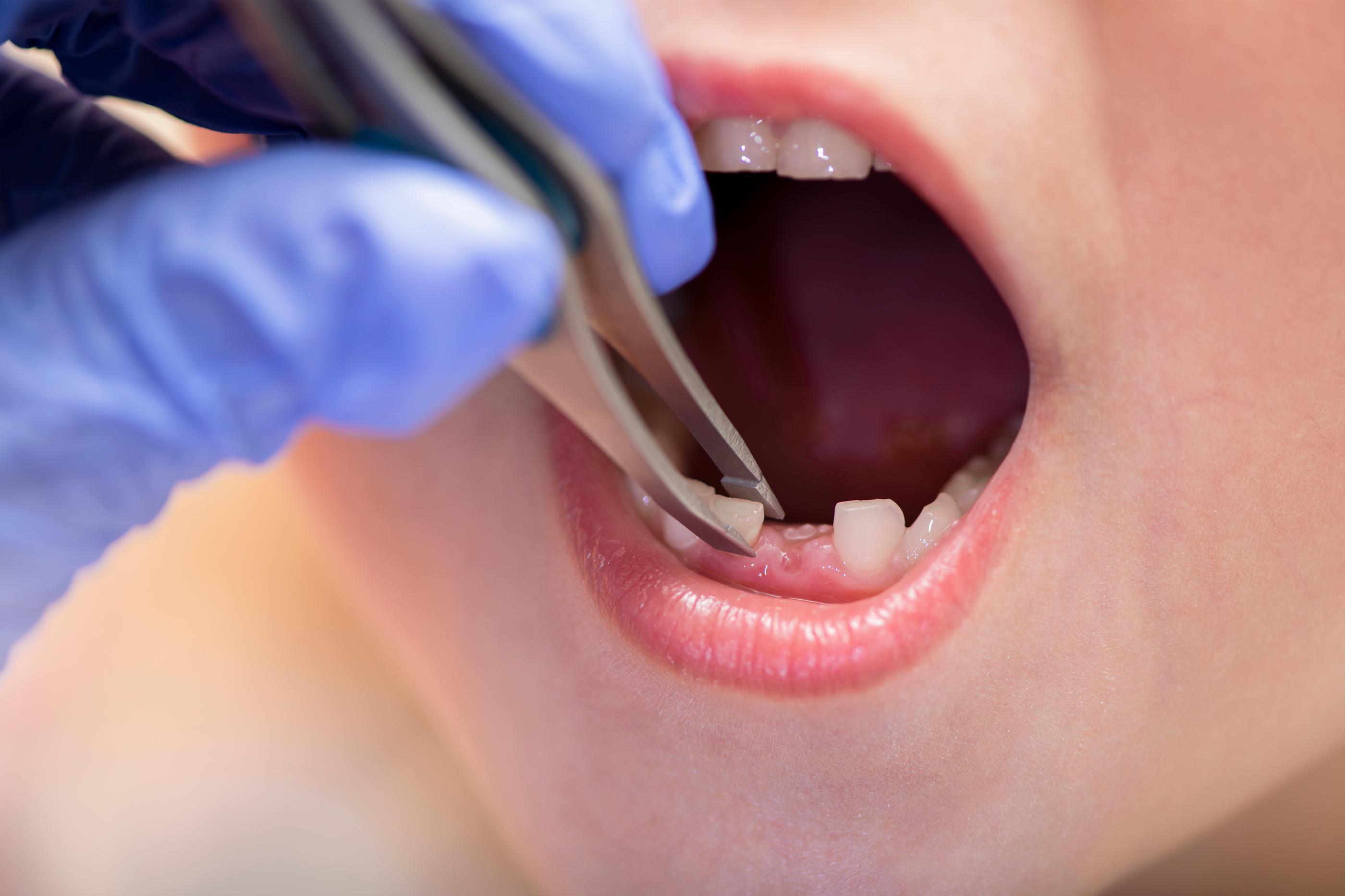 Pediatric Tooth Extraction Round Rock, TX