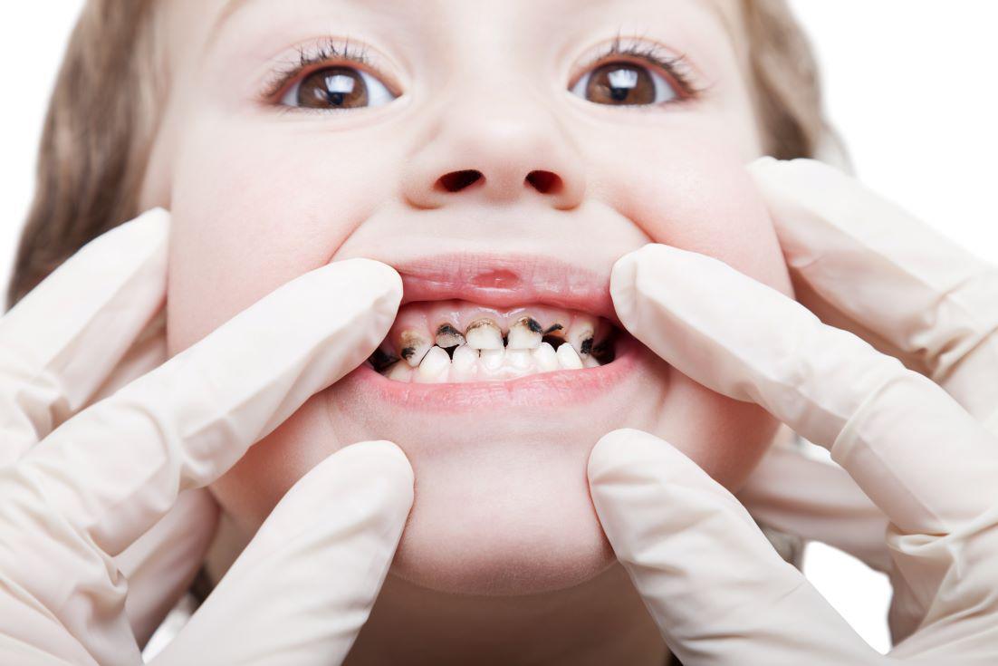 What Causes Tooth Decay in Kids?